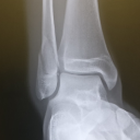 Broken Fibula